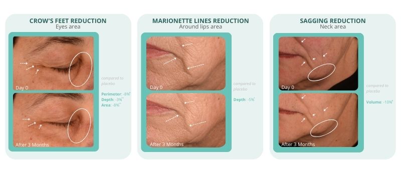 Clinical photos demonstrating EcoPep's visible results over 3 months, showing significant reduction in crow's feet wrinkles, marionette lines, and facial sagging.