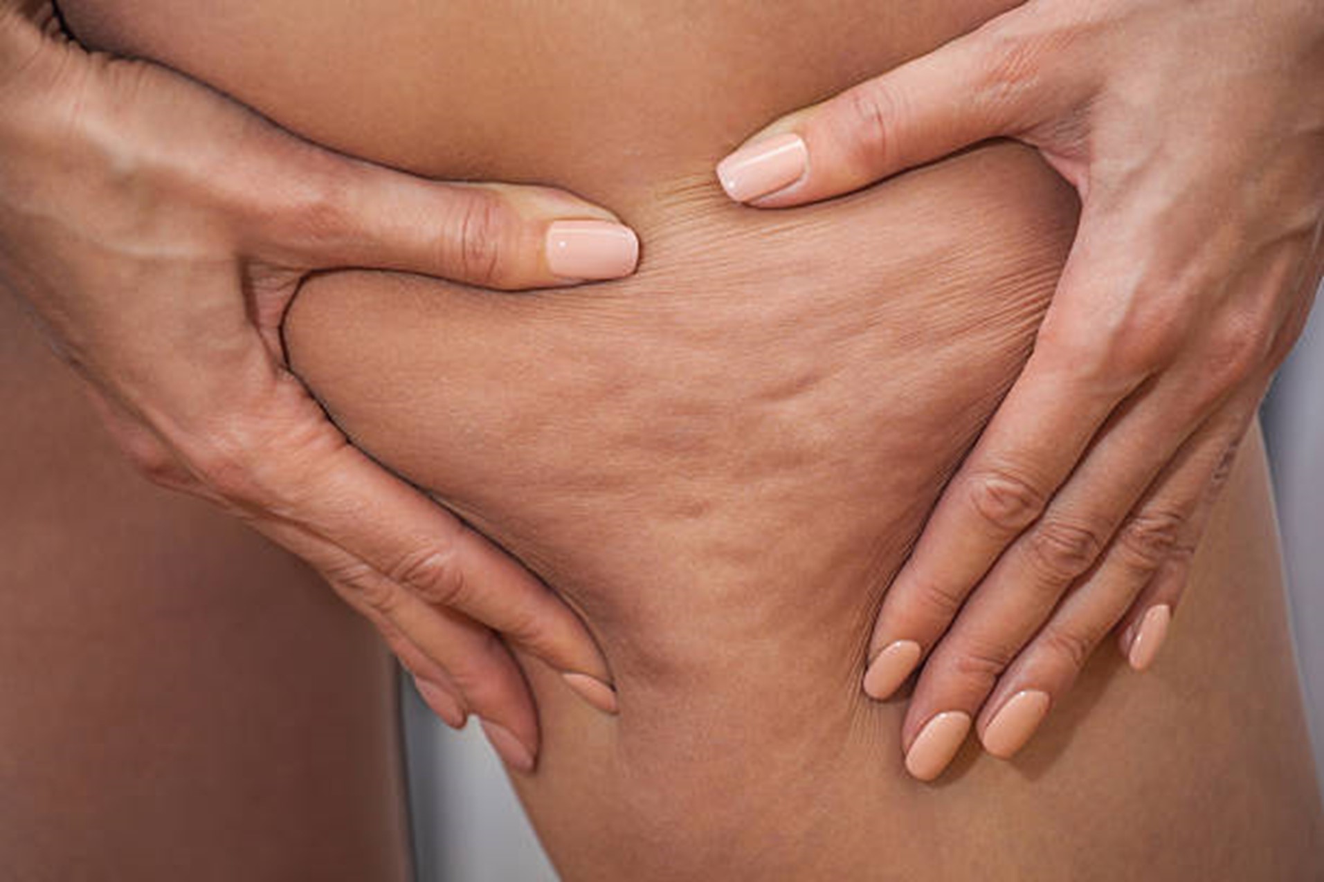 A Scientific Approach to Understanding Cellulite: It has finally met it’s match!